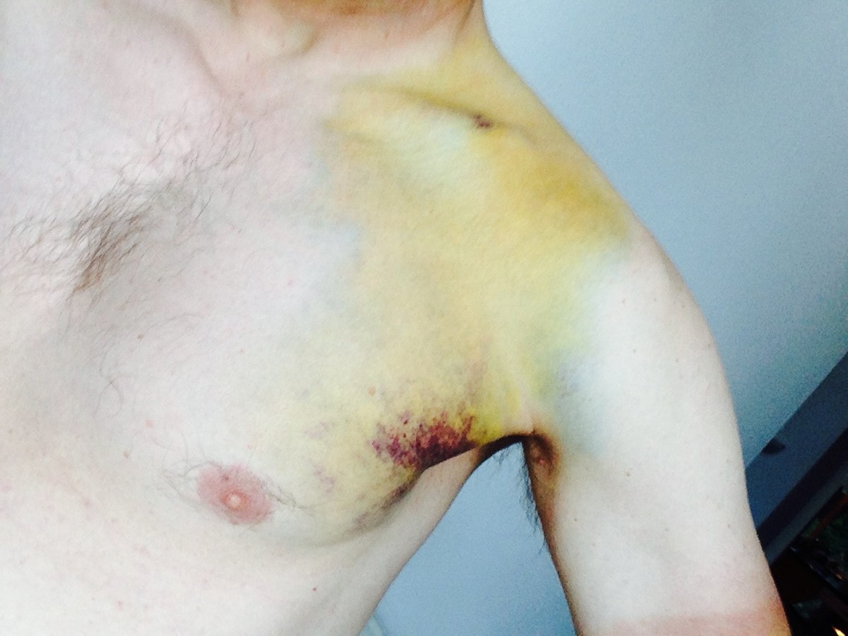 Closeup of the heavy yellow bruise surrounding my broken collarbone