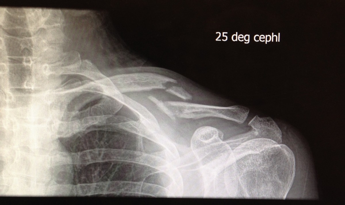 X-ray of my left collarbone, showing clean breaks in two places