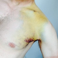 Closeup of the heavy yellow bruise surrounding my broken collarbone