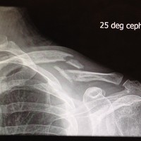 X-ray of my left collarbone, showing clean breaks in two places